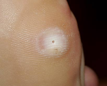 planters warts on feet. The plantars wart that I#39;ve